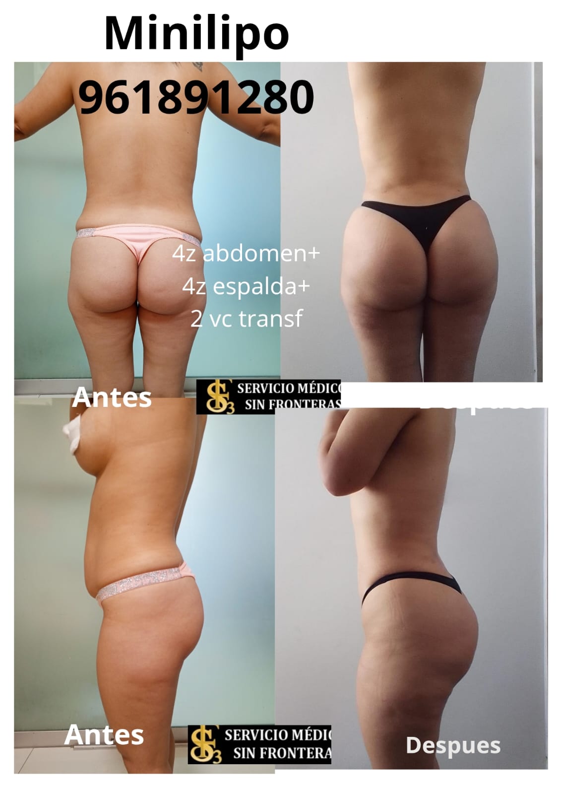 Resultado Lipotransferencia 3